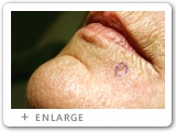 Right Lower Lip Skin Cancer