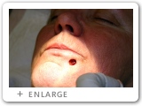 Right Lower Lip Skin Cancer