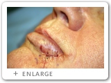 Right Lower Lip Skin Cancer