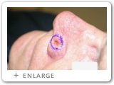 Left Nasal Rim Skin Cancer