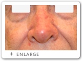 Left Nasal Rim Skin Cancer