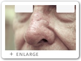 Left Nasal Rim Skin Cancer